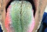 La lengua de un hombre se volvió verde y 'peluda'