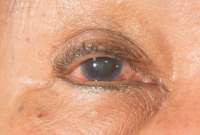 ¿Quiénes tienen mayor riesgo de desarrollar el glaucoma?